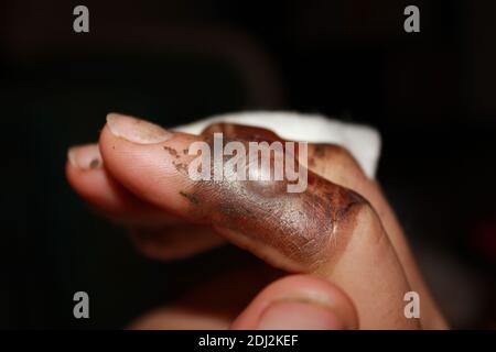 burned fingers with big blisters Stock Photo