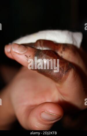 burned fingers with big blisters Stock Photo