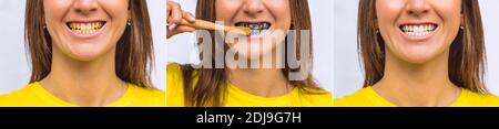 Yellow and white teeth before and after brushing. Black charcoal whitening toothpaste. Stock Photo
