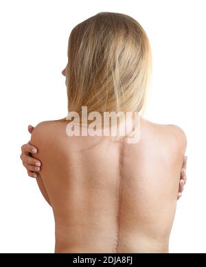Young woman with scars from spinal surgery. Stock Photo