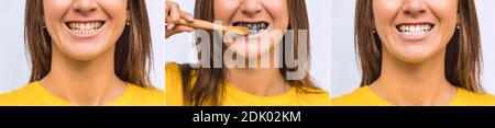 Yellow and white teeth before and after. Black charcoal whitening toothpaste. Stock Photo