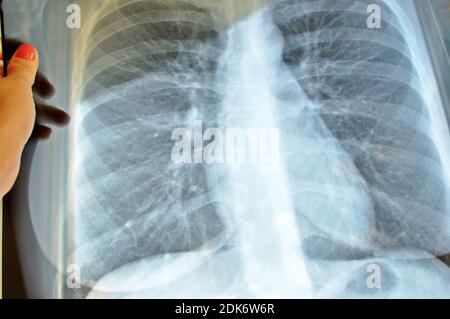 Doctor hands holding a lungs radiography image scan. x-ray film chest or lung of patient for medical diagnose. Pulmonary  medicine exam, science. Stock Photo