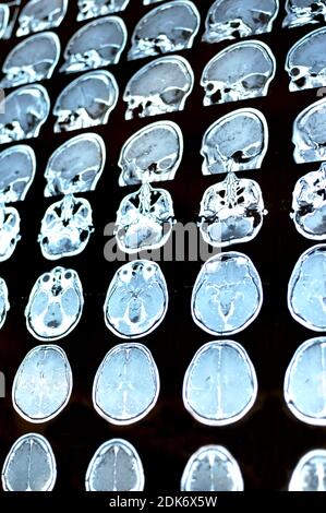 Magnetic resonance image scan of the brain with a colloid cyst. MRI film of a human skull and brain tumor. Neurology background. Medicine, science Stock Photo