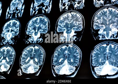 Magnetic resonance image scan of a man brain with a colloid cyst