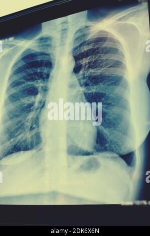 A lungs radiography image scan. x-ray film chest or lung of patient for medical diagnose. Pulmonary medicine, science. Stock Photo