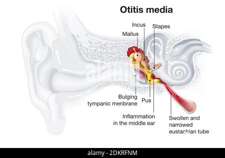 Medically illustration showing inflammation of the middle ear, otitis media Stock Photo