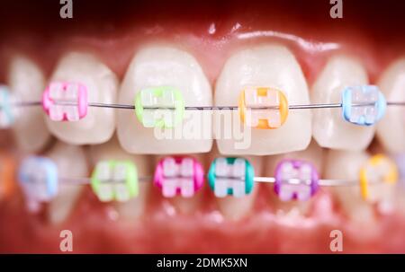 Close up of white teeth with wired orthodontic braces. Patient demonstrating dental brackets with multicolored rubber bands. Concept of dentistry, orthodontic treatment and stomatology. Stock Photo