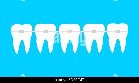 Five teeth with dental braces vector illustration. Orthodontic treatment Stock Vector