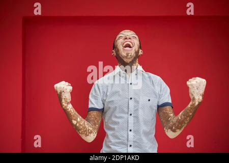 Young man with vitiligo screaming with joy and laughing on a red wall Stock Photo
