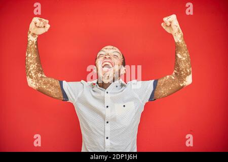 Young man with vitiligo screaming with joy and laughing on a red wall Stock Photo