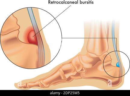 Illustration showing the position of the normal retrocalcaneal bursa in the foot, and in enlarged detail a retrocalcaneal bursitis, annotated on white Stock Vector