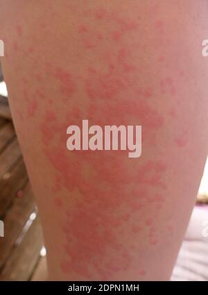 Rash In Food Allergy, Itchy, Hot, Red Wheals, Reddening Of The Skin, Repeatedly Appearing On Other Parts Of The Body Stock Photo