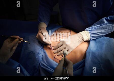 Close up of plastic surgeon hands in gloves using scalpel while doing plastic surgery in clinic. Patient with marks on belly lying on operating table. Concept of cosmetic surgery and abdominoplasty. Stock Photo