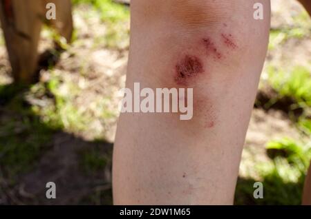 Sport injury - painful knee wound accident. Close up of bleeding scraped human knee after fallen on running Stock Photo