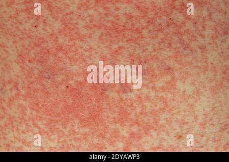 An allergic reaction (side effect) to penicillin (amoxicillin) on the skin of a 51 year old white man in London, UK. Stock Photo