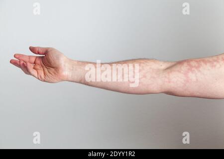 Male arm with red skin capillary network Stock Photo - Alamy