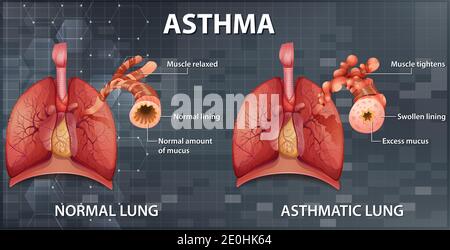 Comparison of healthy lung and Asthmatic lung illustration Stock Photo