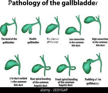 Pathology of the gallbladder. The bend of the gallbladder. Set. Vector illustration on isolated background Stock Vector