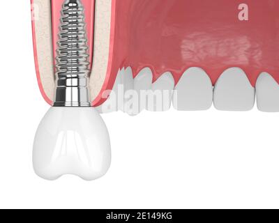 3d render of gum cross-secton with implant placement over white background Stock Photo