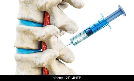 Spinal injection, illustration Stock Photo - Alamy