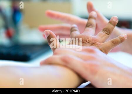 an occupational therapist works the hand of a burnt child Stock Photo