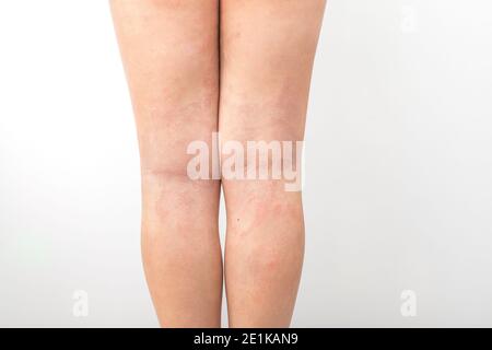 Acute atopic dermatitis on the legs behind the knees of a child is a dermatological disease of the skin. Large, red, inflamed, scaly rash on the legs. Stock Photo