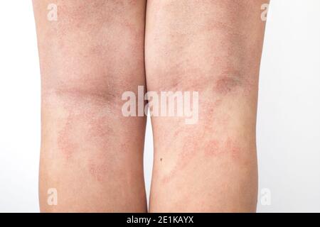 Acute atopic dermatitis on the legs behind the knees of a child is a dermatological disease of the skin. Large, red, inflamed, scaly rash on the legs. Stock Photo