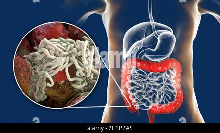 Round worms in human large intestine, illustration Stock Photo