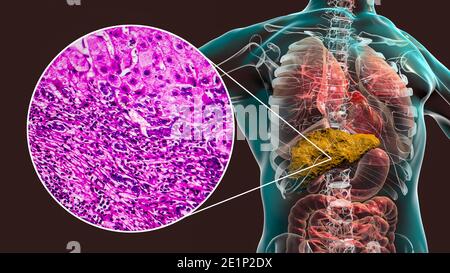 Liver cirrhosis, illustration and light micrograph Stock Photo