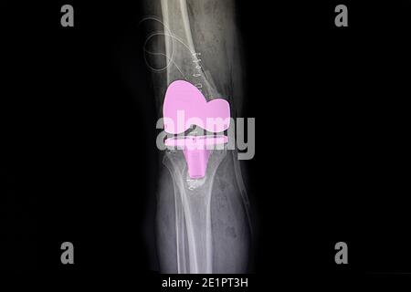 the xray film of a patient right knee after total knee arthroplasty operation. Stock Photo