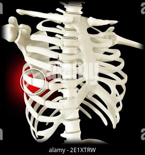 Anatomy and the human body. Costochondral separation, separated rib. Broken, fractured ribs. Bones in the rib cage breaks or cracks. Chest lungs Stock Photo