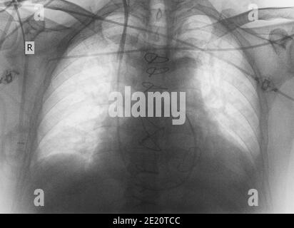 X-ray image of patient after cardiac surgery Stock Photo - Alamy