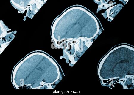 MRI scan image of head as medical background. Stock Photo