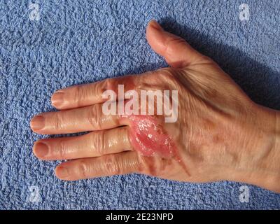 Top view of a woman arm with severe scars from burns on the skin Stock Photo