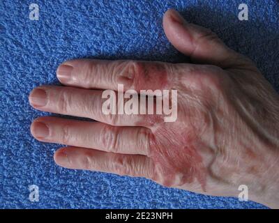 Top view of a woman arm with severe scars from burns on the skin Stock Photo