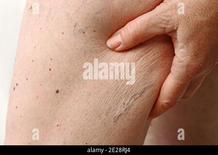 Spider veins, varicose veins and cellulite on a woman's leg Stock Photo