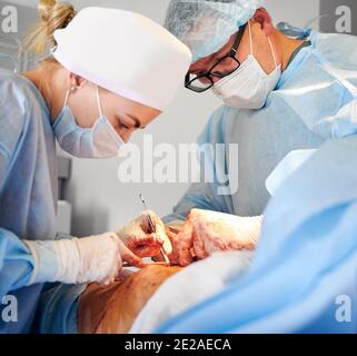 Doctors performing abdominoplasty surgery in the hospital. Focus on male plastic surgeon doing abdominal plastic surgery in operating room. Concept of tummy tuck and cosmetic surgery. Stock Photo