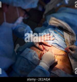 Focus on male doctor's hands in sterile gloves placing sutures after tummy tuck surgery. Medical worker performing abdominal plastic surgery in operating room. Concept of abdominoplasty. Stock Photo