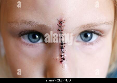 Close up on a young child's face and eyes, with stitches down the bridge of her nose from an injury. Stock Photo