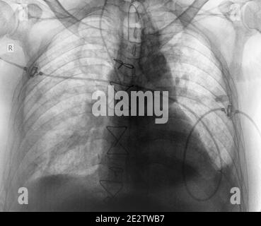 After surgery x-ray of patient with suture Stock Photo - Alamy
