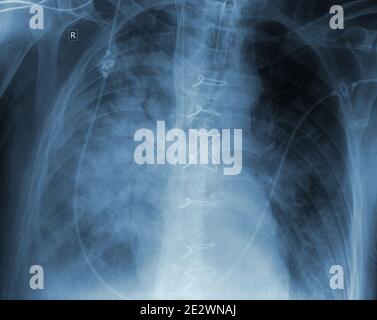 After surgery x-ray of patient with suture Stock Photo - Alamy