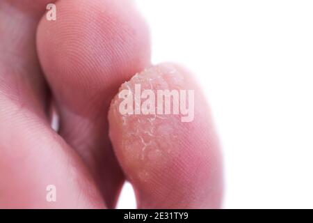 A case of verruca or plantar warts on the bottom of the small toe.  A close photo of a wart. Warts require treatment. Stock Photo