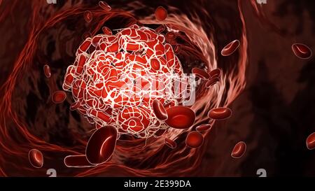 Thrombus or blood clot inside a blood vessel flowing with red blood cell 3D rendering illustration. Vein thrombosis, cardiovascular disease, medicine, Stock Photo