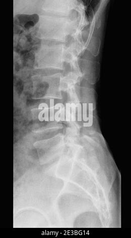 Human Lumbar Spine x-Ray side view Stock Photo - Alamy
