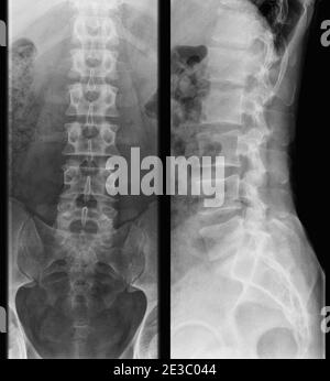 x-ray photo of human lumbar spine - adult man, side view Stock