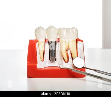 Dental prosthetics, close-up. Mouth mirror near of an anatomical model of jaw Stock Photo