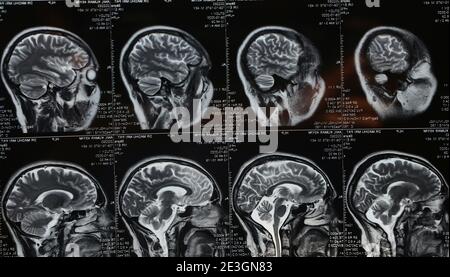 MRI Brain Scan of Head and Skull Stock Photo