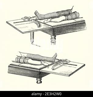An old engraving of the use of splints for a leg fracture in the 1800s. It is from a Victorian mechanical engineering book of the 1880s. ‘Latta’s splints’ keep a leg in traction and immobilised by means of spring balance to extend the bandaged, injured leg and a rod and cross-bar system connected to another splint on the thigh of the sound leg. Stock Photo