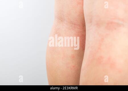 Acute atopic dermatitis on the legs behind the knees of a child is a dermatological disease of the skin. Large, red, inflamed, scaly rash on the legs Stock Photo