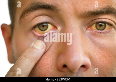 Young man with yellowish eyes and skin. Jaundice, liver disease Stock Photo